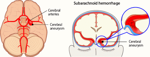 Subarachnoid Hemorrhage - What You Need to Know