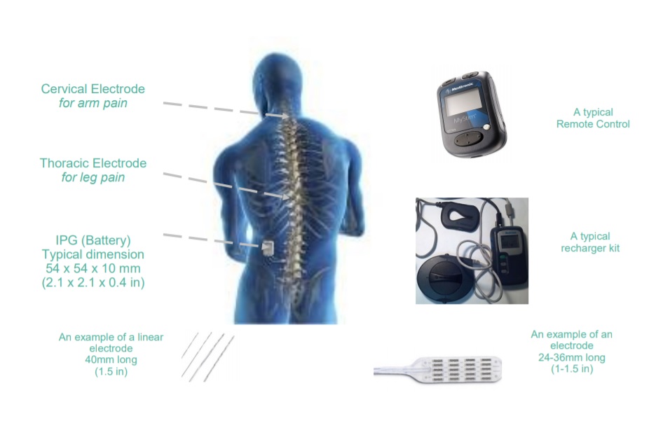 Pain Relief via a Spinal Cord Stimulator